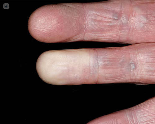 Navigating Raynaud's Disease: Unveiling Symptoms and Genetic Polymorphisms